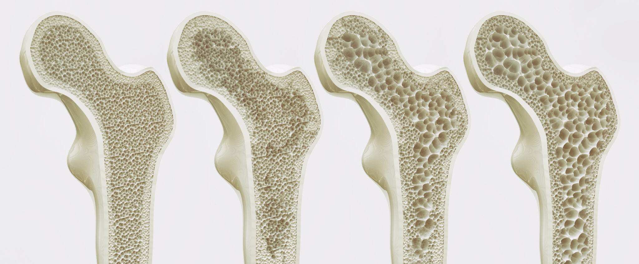An image depicting various stages of bone health, from healthy to Osteoporotic.